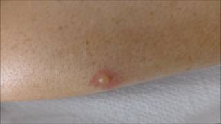 blisters from mosquito bites  before and after treatment [upl. by Dee Dee]