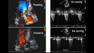 The Walls of the Heart are Thick – Case of Amyloidosis HCM Microlesson Case Example 3 [upl. by Doy]