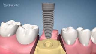 Dental Implant Procedure  One Stage [upl. by Risley]