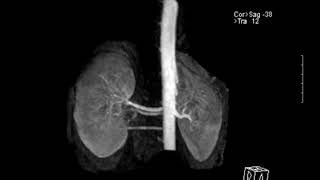 MRA Of The Renal Artery [upl. by Chanda]