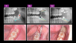 Lower Impacted Molar with Ramus Screw amp aligner｜【Chris Chang Ortho】CC759 [upl. by Aretahs]