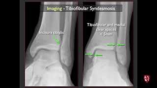 Imaging of the Tibiofibular Syndesmosis and High Ankle Sprain [upl. by Malkah]