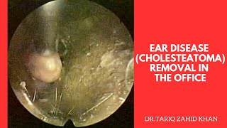 EAR diseaseCholesteatoma removal in the office [upl. by Shakespeare]