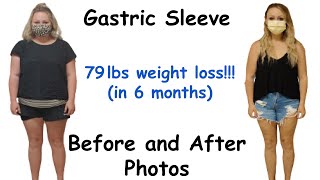 Gastric Sleeve Before and After Pictures and Results part 3  Bariatric Weight Loss Journey [upl. by Bettye251]