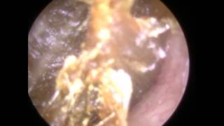 Impacted Ear Wax Removed from Ear  Mr Neel Raithatha The Hear Clinic [upl. by Thanh]