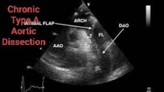 Chronic Type A Aortic Dissection CTAD Echocardiography post AVR [upl. by Rosmunda]