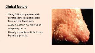 Lecture90 Acquired disorders of Epidermal keratinization PartII Rooks chapter 87 [upl. by Mayce33]