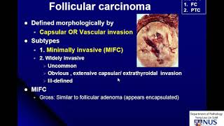 Thyroid Carcinoma Gross and Micro [upl. by Aihc476]