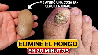 Los hongos de las uñas se pueden eliminar en 20 minutos en casa con un simple [upl. by Pack358]