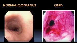 Diagnosis and Treatment for Esophageal and Motility Disorders Video  Brigham and Womens Hospital [upl. by Adnik765]