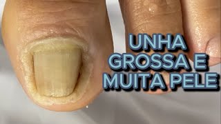 UNHA GROSSA E MUITA PELE satisfying viral [upl. by Duthie]