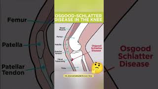 What is Osgood  Schlatter Disease physiotherapypainmodalitiesyoutube [upl. by Oicapot512]