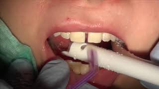 How to close gap between front teeth Cosmetic Dentistry Los Angeles CA Tel 8187760055 [upl. by Trela528]