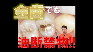 金歯でも油断禁物！【王子本町歯科クリニック】 [upl. by Patience]