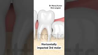 Horizontally impacted 3rd molar dentist doctor smile dental dentaldoctor anatomy molars [upl. by Wun677]