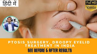 हिंदी में Ptosis Surgery Droopy Eyelid Treatment in India  Before amp After Results TEC [upl. by Ettelohcin]