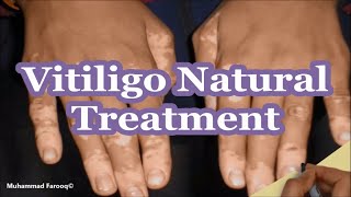 How To Cure Vitiligo Fast And Permanently Naturally At Home  Muhammad Farooq  mmfarooq7861 [upl. by Jay]