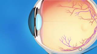 What is glaucoma [upl. by Dukie621]