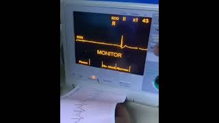 Adenosine administration in psvt [upl. by Paehpos]