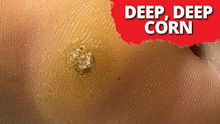 DEEPSeated Corn Removal On Dancer MUST WATCH [upl. by Kunin]