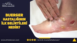 Buerger Hastalığının İlk Belirtileri Nedir  Prof Dr Mustafa Hakan Zor [upl. by Cirted]