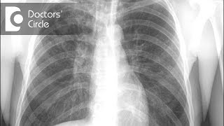 How to manage Tuberculosis of bone amp lungs  Dr Sanjay Panicker [upl. by Mayfield]