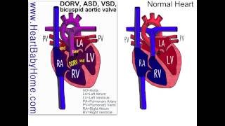 38 Double Outlet Right Ventricle with ASD VSD bicuspid aortic [upl. by Catherine]