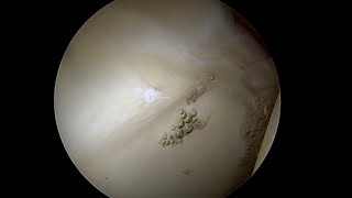 Debonded Articular Cartilage Lifting off the Bone as Labrum is Stressed [upl. by Price]