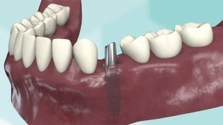 Animation Remplacement Dent Unitaire [upl. by Etsirhc]