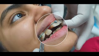 Correcting a BlockedOut Lateral Incisor Treatment Options and Solutions orthodontics [upl. by Payne]