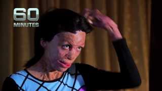 TURIA PITT  60 MINUTES [upl. by Einhpets]