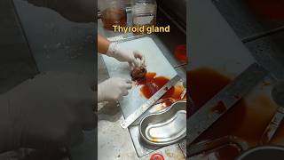 Cystic thyroid gland gross pathology [upl. by Eleonore]