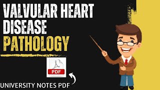 Valvular Heart Disease  CVS  Systemic Pathology  Pathology MBBS [upl. by Pennebaker]