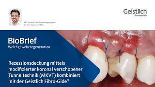 Rezessionsdeckung mittels modifizierter koronal verschobener Tunneltechnik MKVT [upl. by Thorstein]