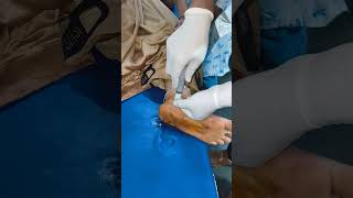 INTRAARTICULAR INJECTION FOR ANKLE PAIN [upl. by Andriana]