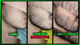 1 ANO E 7 MESES usando MINOXIDIL veja como ocorre o EFEITO SHEDDING [upl. by Inirt]