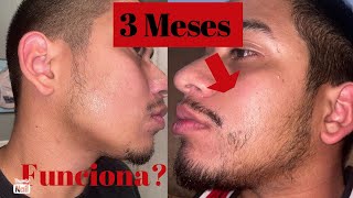 3 MESES usando MINOXIDIL En VERDAD funciona🤔 [upl. by Beare7]