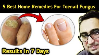 Top 5 Remedies To Cure Nail Fungus Just In 7 Days At Home  Pharmacist Javaid [upl. by Acalia]