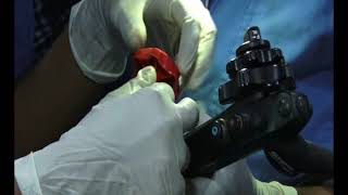 Endoscopic banding of esophageal varices [upl. by Itirp458]