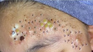 Big Cystic Acne Blackheads Extraction Blackheads amp Milia Whiteheads Removal Pimple Popping  3905 [upl. by Elmo]