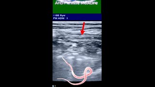 Long Ascaris Worm  in Small Intestine of 8 yrs Old Boy ultrasound [upl. by Annet]