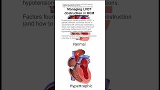 Managing left ventricular outflow tract LVOT obstruction in hypertrophic cardiomyopathy HCM [upl. by Jacobo838]