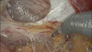 Robotic Repair of Left Sided Spigelian Hernia [upl. by Anuqahs]