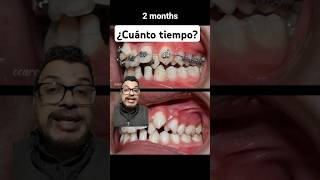 ¿Cuánto TARDA una Ortodoncia feat nhakhoaocare  odontologia [upl. by Daniela794]