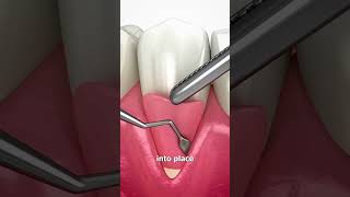 Dental Hygienist reacts and explains reaction gumrecession shorts [upl. by Inverson786]