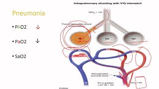 USMLE Step 1 How to solve VQ mismatch questions the Aa gradient [upl. by Handal]