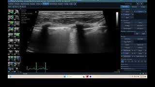 iq 306 tfast lung ultrasound echopac analysis PTE THROMBOEMBOLISM [upl. by Madson617]