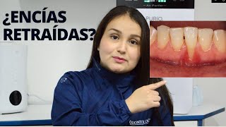 ¿SUFRES DE ENCÍAS RETRAÍDAS RECESIONES GINGIVALES CAUSAS Y TRATAMIENTO [upl. by Rizas]