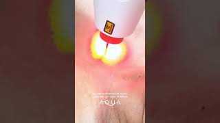 Rejuvenecimiento de cuello y escote con el láser ETHEREA laser medico antiage [upl. by Marcell429]