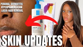 SKIN UPDATES Perioral Dermatitis amp Laser Hair Removal Dark Skin [upl. by Brittaney]